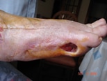 La úlcera después de 4 meses de tratamiento.