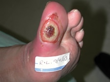 Úlcera del pie infectado