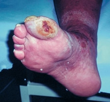 Úlcera del pie isquémico