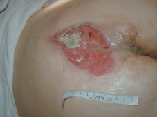 La úlcera después de una semana de tratamiento.