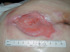 La úlcera después de cuatro semanas de tratamiento.
