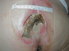 La úlcera al inicio del tratamiento.