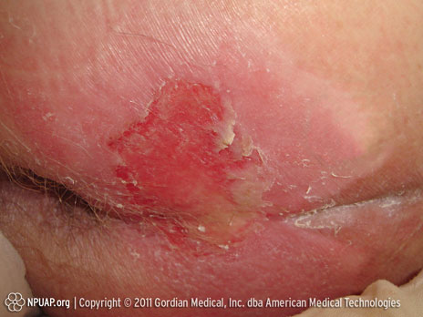 Úlcera por presión Categoría/Etapa II: Pérdida parcial del grosor de la piel o ampolla  