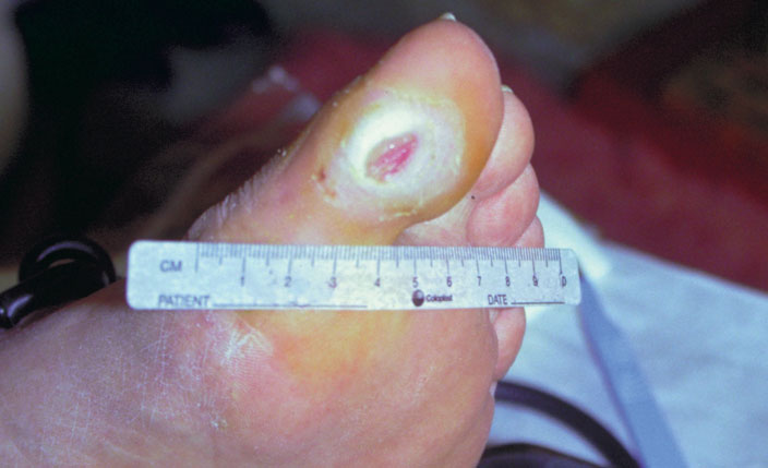 úlcera del pie neuropático