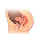 Cystocele Cystocele