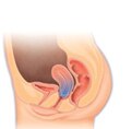 Uterine prolapse Uterine prolapse