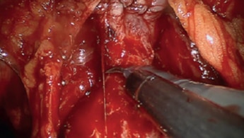 Prostatectomía
